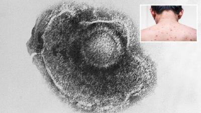 One Person Transmits Disease to 13 Others: Warnings About a Serious Illness Spreading Faster than COVID-19