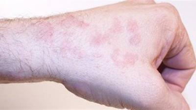 Researchers Develop Injections for Skin Cancer Treatment