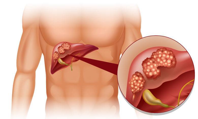 Discovery of a New Therapeutic Target for Liver Cancer