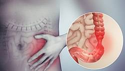 5 Steps to Prevent Colon and Rectal Cancer