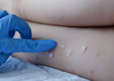 First Case of Monkeypox in Pakistan