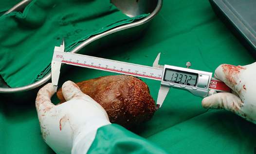 Removal of the World's Largest Kidney Stone... and Guinness Welcomes It