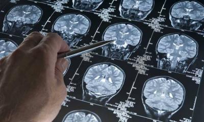Severe COVID-19 Infections: Connection Between the Disease and Brain Aging