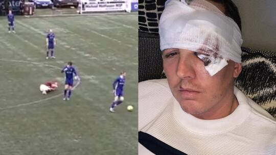 بالفيديو.. لاعب ينطح منافسه بوحشية كادت تفقده عينه