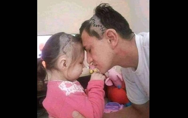 صورة تجسد قمة الإنسانية.. رجل يحلق شعر رأسه ليبدو مثل ابنته بعد جراحة في دماغها