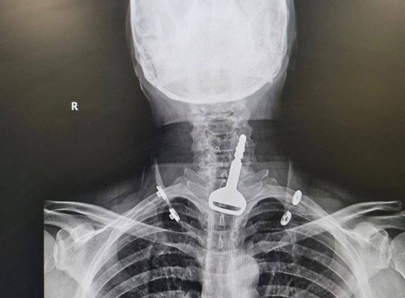 Title: Saudi Surgeon Saves Man Who Swallowed Car Key