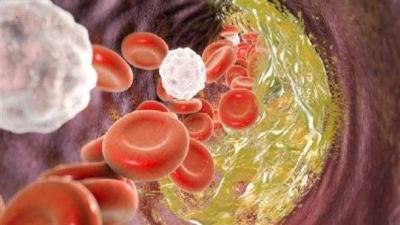 Drink That Breaks Cholesterol and May Lower Elevated Levels!