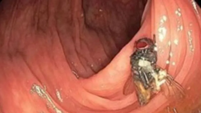 "Live Fly Found in Man's Intestines" Baffles Doctors