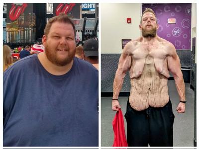 Shocking Image of Man Who Lost 152 kg