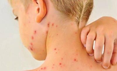 Romania Announces Widespread Measles Outbreak
