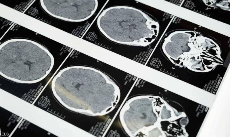 Strokes in Younger Age Groups: Alarming Spread and Missing Explanations