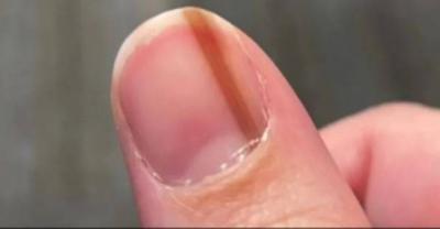 عانت من خط تحت ظفرها لـ10 سنوات.. ثم اكتشفت 