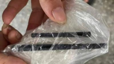 Chopsticks Pierced Patient's Skull and Remained for 5 Months