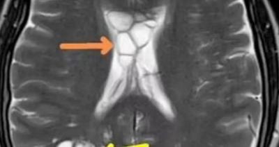 Title: Man Discovers Chronic Headaches Caused by Brain-Crawling Parasite