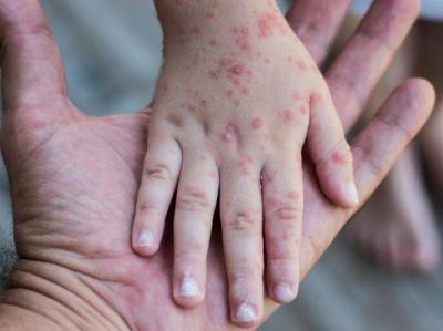 State of Emergency Declared in Britain Amid Serious Measles Outbreak Warning