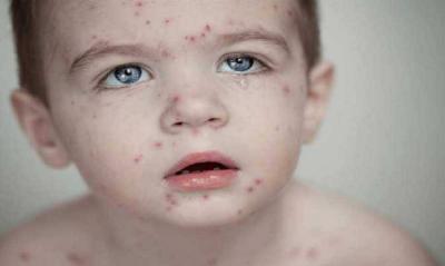 WHO Warns: Measles Makes a Strong Comeback in Europe
