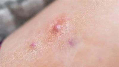 Rare and Painful Skin Disease... Treatment Available in This Drug