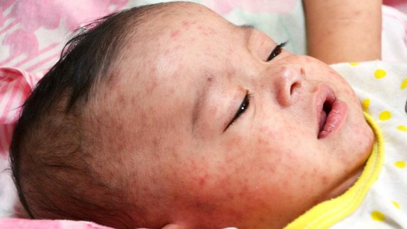 Alarming Rise in Measles Cases Worldwide