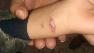 Worrisome Spread of Leishmaniasis Among Children in Libya