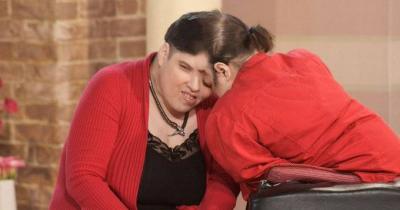 Death of the World's Oldest Conjoined Twins