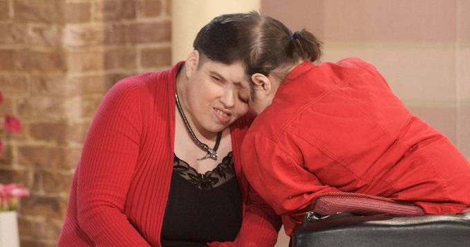 Death of the World's Oldest Conjoined Twins