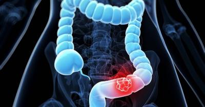 Advice Revealed to Reduce the Risk of Bowel Cancer