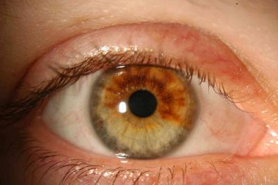Unclear Symptoms of Eye Cancer