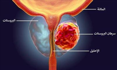 Study: Obesity Increases Risk of Death from Prostate Cancer