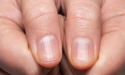 "Nail Fungi": Symptoms and Prevention Methods!