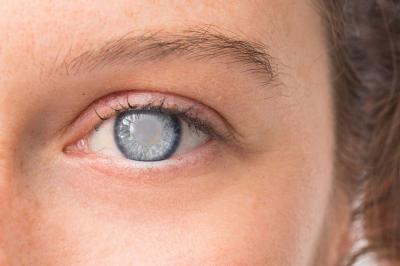 Early Signs of Cataracts