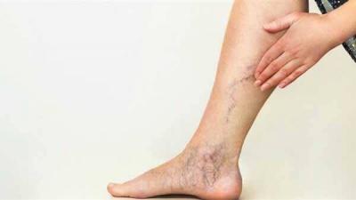 Doctor Warns About the Danger of Aneurysms