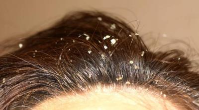 Tips to Get Rid of Dandruff