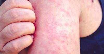 Measles in Iraq: The Ministry Reveals Death Figures and Urges Vaccination