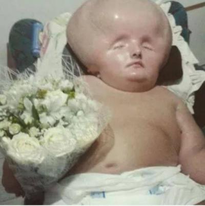 Rare Condition: Giant Girl with Continuously Enlarging Head