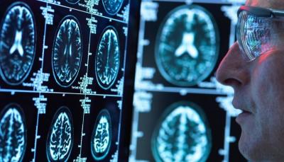 3 Things to Avoid Alzheimer’s Disease