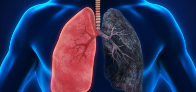 Development of a "Pioneering" Lung Cancer Vaccine