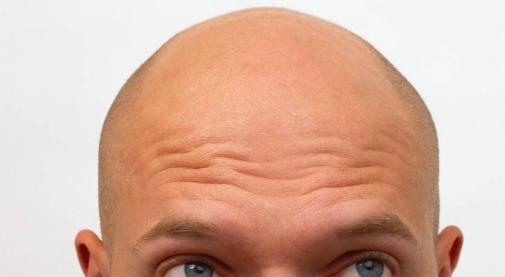 Strangest Divorce Case: After Two Days of Marriage, She Discovered He Was Bald