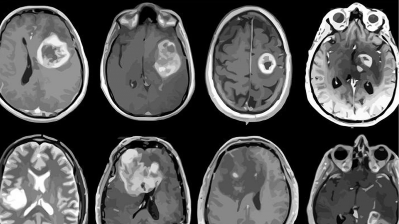 Neurological Conditions Lead Globally in Causes of Disability