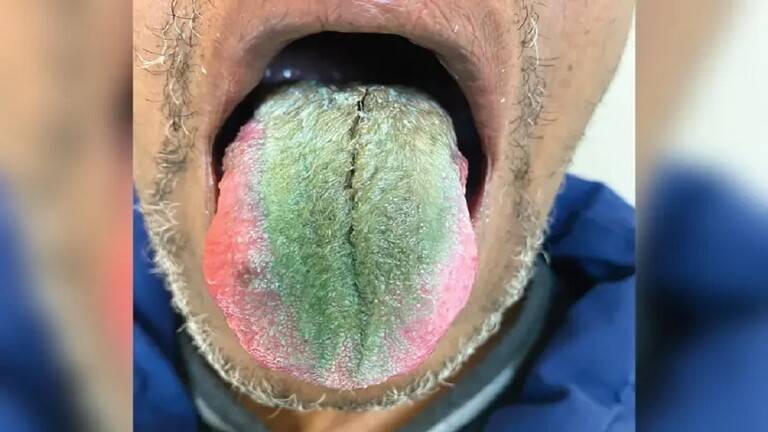 Title: Hair Growth on the Tongue Due to Smoking and Antibiotics