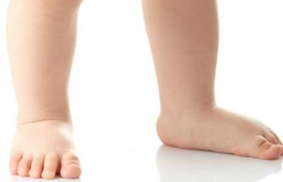 Flat Feet: A Deformity with No Cure Except Surgery, and High Heels Worsen the Condition