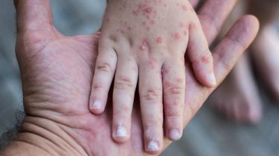 Title: Philippines Records First Case of "Monkeypox"