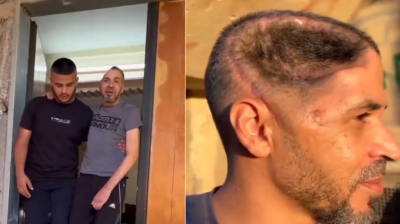 Palestinian Who Lost Part of His Skull Shares Terrifying Details