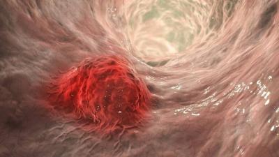 Can Diet Change the Course of Cancer?