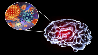 Warning of Serious Cases from a Frightening Virus on the Rise