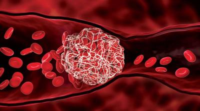 Unprecedented Achievement: Iraq Produces a Treatment that Prevents "Blood Clots"