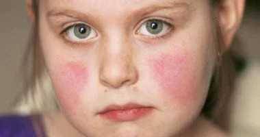 "Fifth Disease" Outbreak After Appearance in 3 Private Schools in Zahle
