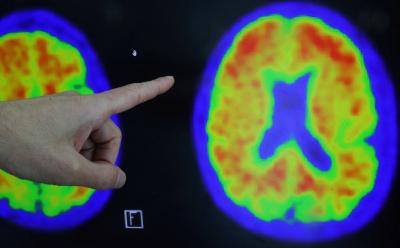 Promising Results of Stem Cells in Eliminating Alzheimer’s Disease
