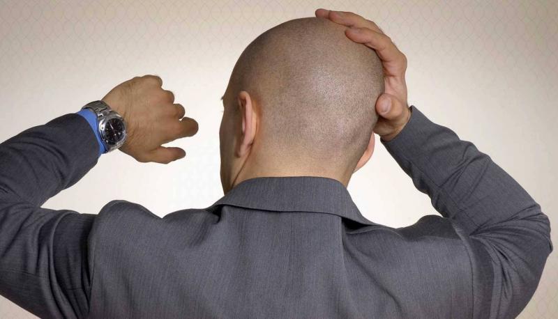 Discovery of Rare Genetic Mutations Behind Male Baldness
