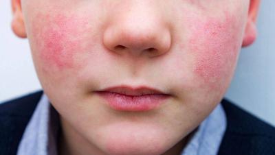 New Virus Causes Panic in Lebanon and School Closures!
