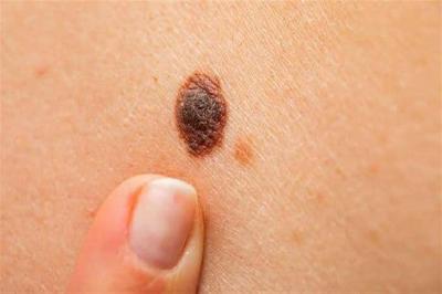 Skin Cancer: Beware of Falling for "Misinformation"